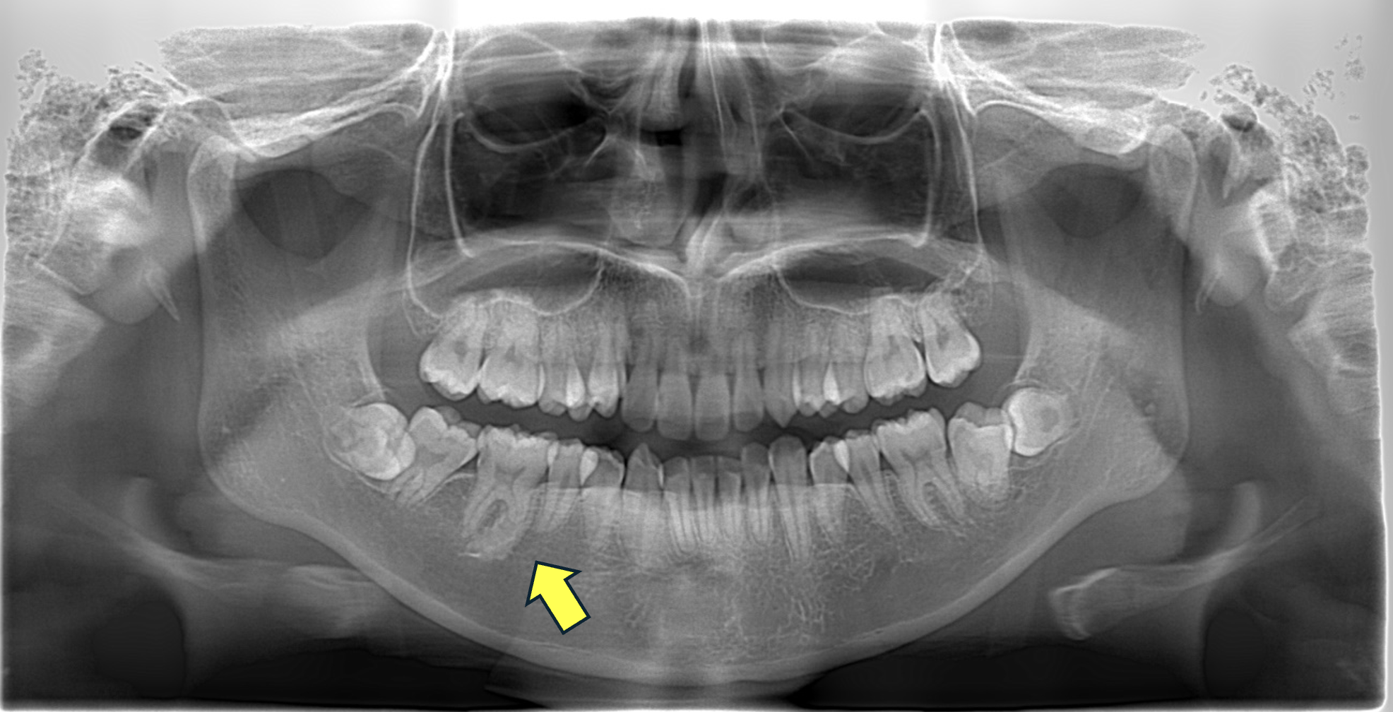 X線画像診断例1